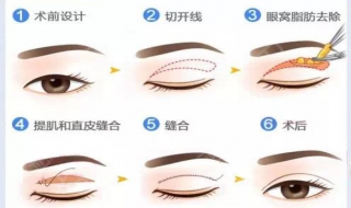 眼皮松弛怎么办 女生上眼皮松弛怎么办