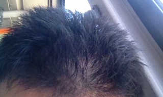 头发稀疏怎么办（15岁男孩头发稀疏怎么办）