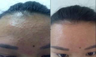 额头上的痘痘怎么办（额头上的痘痘应该怎么办）