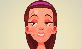 面部痤疮怎么办 面部痤疮怎么办快速消除