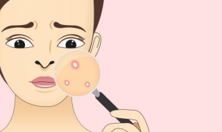 长痤疮了怎么办（长痤疮怎么办用痤康王）