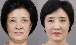 面部皮肤松弛怎么办 40岁面部皮肤松弛怎么办