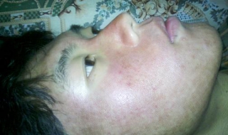 皮肤发红怎么办（长期卧床皮肤发红怎么办）