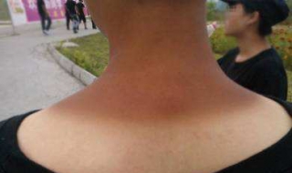 夏天晒黑了怎么办（夏天晒黑了怎么办变白）