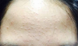 额头上长粉刺怎么办（小女孩青春期额头上长粉刺怎么办）