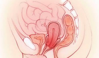 子宫移位怎么办（子宫移位怎么办才能恢复）