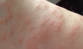 孕妇得了湿疹怎么办 孕妇得了湿疹怎么办 有什么治疗方法