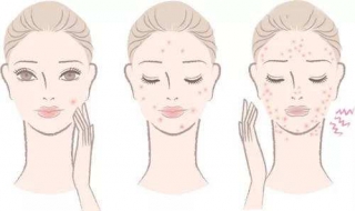 得了青春痘怎么办（得了青春痘怎么办能治好吗）