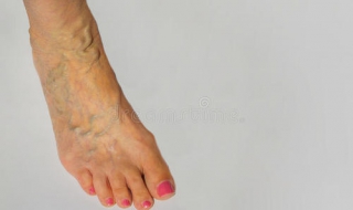 得了静脉曲张怎么办（得了静脉曲张怎么办呢怎么治啊）