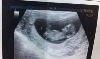 怀孕一个月怎么办 怀孕一个月怎么办不想要孩子