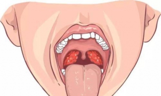 扁桃体化脓怎么办（经常扁桃体化脓怎么办）