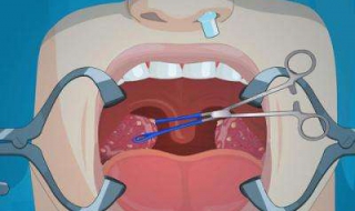 扁桃体发炎怎么办（扁桃体发炎怎么办吃什么药）