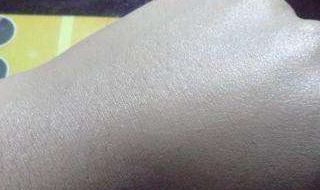 手上毛孔粗大怎么办 手上毛孔粗大怎么回事