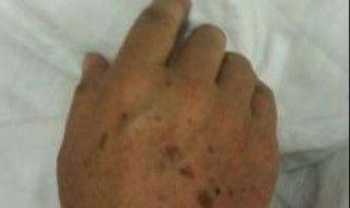 手上的老年斑怎么办 手上上老年斑怎么办