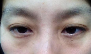 黑眼圈很重怎么办 黑眼圈很重怎么办去黑眼