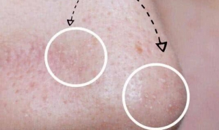 鼻子上的黑头怎么办（鼻子上黑头多怎么去除）