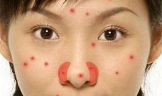 鼻子上长痘痘怎么办 12岁鼻子上长痘痘怎么办