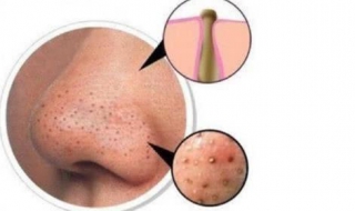 鼻子上黑头多怎么办 鼻子上黑头多怎么办图片