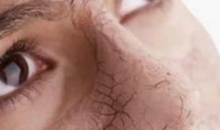 鼻子发干怎么办（新房子鼻子发干怎么办）