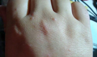 手被开水烫了怎么办（小孩子手被开水烫了怎么办）