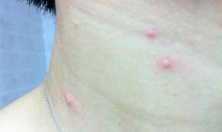 脖子上长小肉疙瘩怎么办（哺乳期脖子上长小肉疙瘩怎么办）