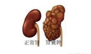 肾囊肿怎么办 女人右肾囊肿怎么办