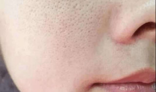 皮肤变粗糙怎么办（皮肤变粗糙怎么办）