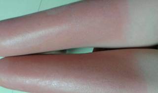 皮肤晒伤了怎么办（皮肤晒伤了怎么办通红）