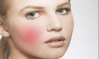 脸红有红血丝怎么办 脸红还有红血丝怎么办