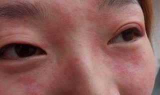 脸皮肤过敏怎么办（小孩脸皮肤过敏怎么办）