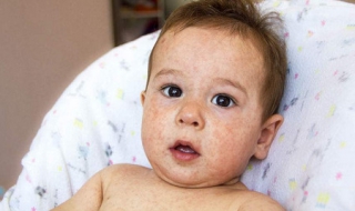 手上起湿疹怎么办 怀孕了手上起湿疹怎么办