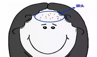 额头的痘痘怎么办（额头痘痘怎么办,越来越严重）