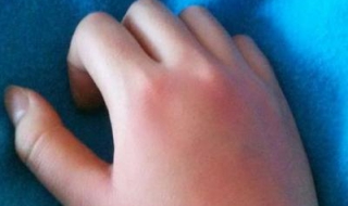 被开水烫了怎么办（嘴里被开水烫了怎么办）