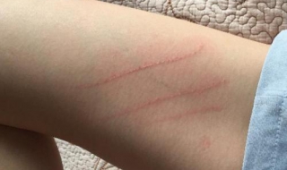 被狗狗抓伤怎么办（被自己狗狗抓伤了怎么办）