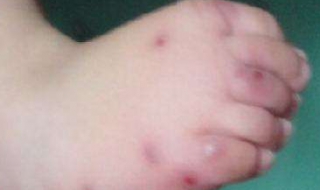 小孩起水痘怎么办（5岁小孩起水痘怎么办）