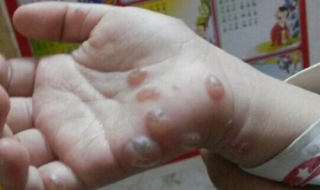 小孩长水痘怎么办 十岁小孩长水痘怎么办