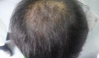 为什么头顶头发稀少（为什么头顶头发稀少后边多）