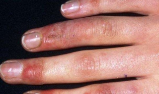 手上长冻疮怎么办 一岁半宝宝手上长冻疮怎么办