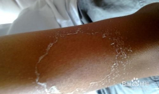 皮肤严重晒伤怎么办 皮肤晒伤该怎么办