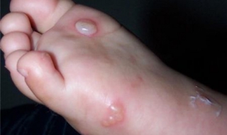 脚上起水泡很痒怎么办 脚上起水泡很痒怎么办用什么药