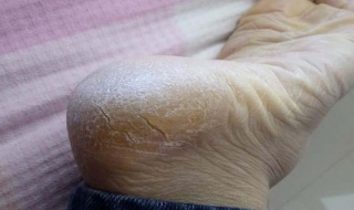 脚后跟干裂起硬皮怎么办（脚后跟干裂起硬皮怎么办用什么药）