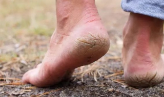 脚后跟开裂怎么办 冬天脚后跟开裂怎么办