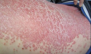 脸上长癣怎么办 小儿脸上长癣怎么办