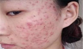 脸上长红痘痘怎么办（脸上长红痘痘怎么办用什么药）