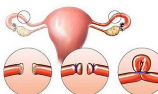 输卵管不通怎么办 造影检查输卵管不通怎么办