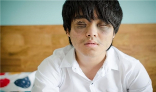 长期有黑眼圈怎么办 长期有黑眼圈是怎么回事 怎么能治好