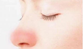 鼻子发红怎么办（用手挤黑头鼻子发红怎么办）