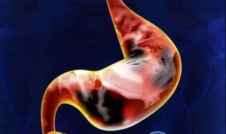 胃出血的治疗方法（阿司匹林肠溶片引起的胃出血的治疗方法）