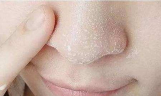 鼻子有黑头怎么去除（鼻子有黑头怎么去除最有效药膏）