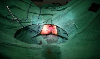 女尖锐湿尤是怎么引起的 尖锐湿尤怎么引起的?